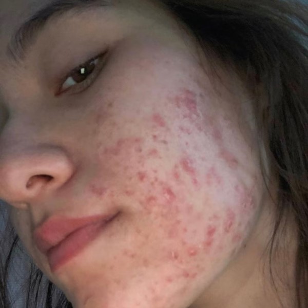 post accutane hair loss