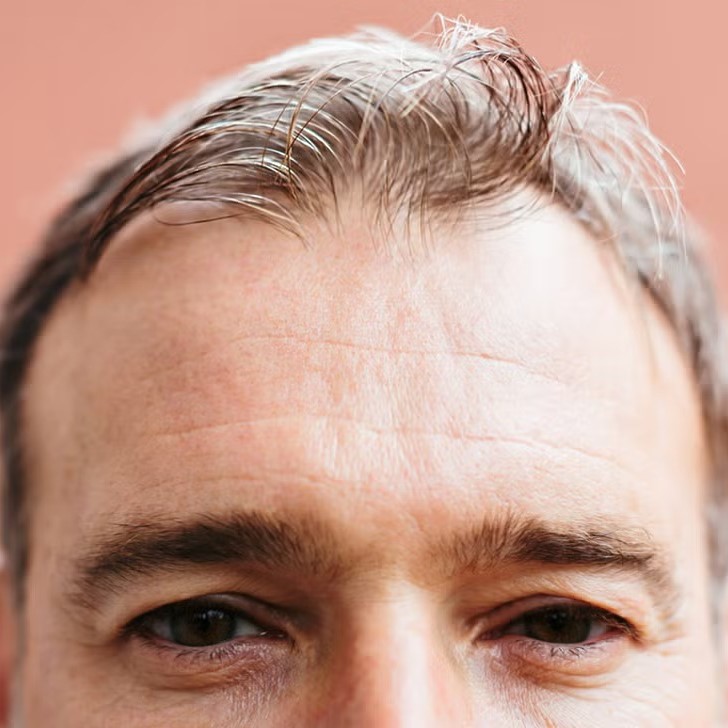 post accutane hair loss